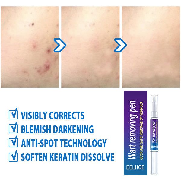 EELHOE Skin Tag and Wart Removal Liquid Pen