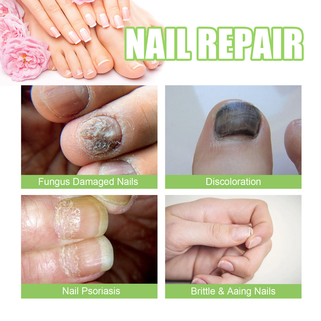 Ximonth Nail Repair Essence for Thickening and Care