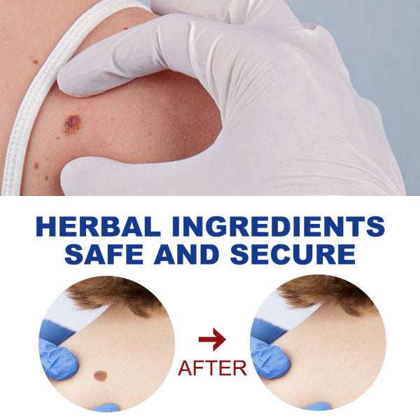 EELHOE Skin Tag and Wart Removal Liquid Pen